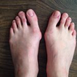 Bunion Pain