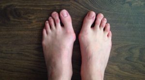 Bunion Pain